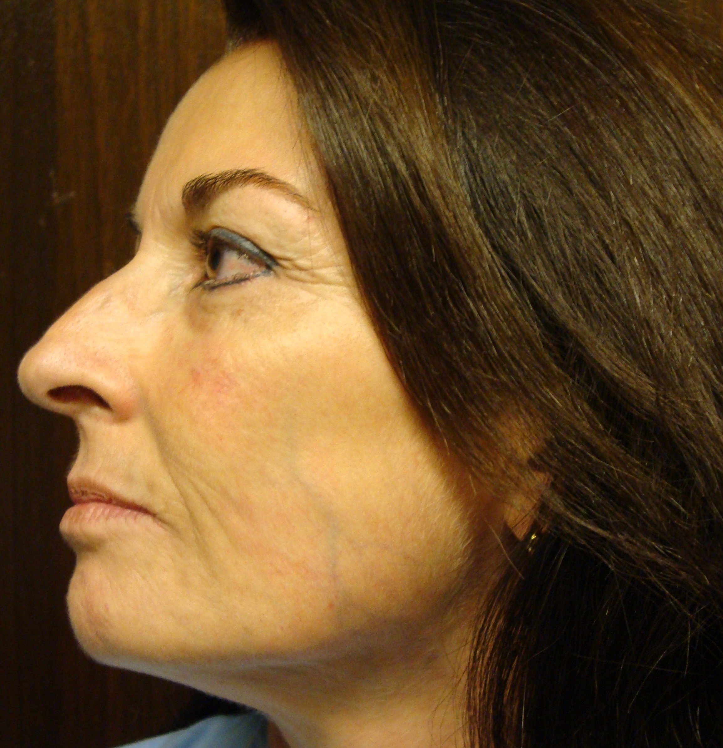 FACIE TIPICA DEL SINDROME DE EHLERSDANLOS VASCULAR (SEDV) (SEDIV)